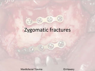 Maxillofacial Trauma El-Hawary
Zygomatic fractures
 