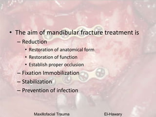 Maxillofacial Trauma El-Hawary
• The aim of mandibular fracture treatment is
– Reduction
• Restoration of anatomical form
...