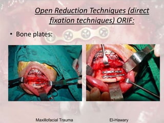 Maxillofacial Trauma El-Hawary
Open Reduction Techniques (direct
fixation techniques) ORIF:
• Bone plates:
 