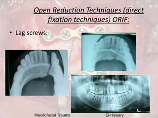 Maxillofacial Trauma El-Hawary
Open Reduction Techniques (direct
fixation techniques) ORIF:
• Lag screws:
 