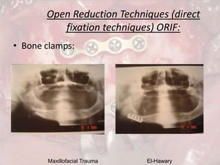 Maxillofacial Trauma El-Hawary
Open Reduction Techniques (direct
fixation techniques) ORIF:
• Bone clamps:
 