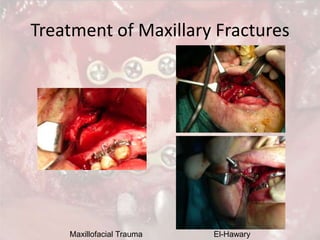 Maxillofacial Trauma El-Hawary
Treatment of Maxillary Fractures
 