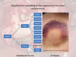 Maxillofacial Trauma El-Hawary
Classification according to the exposure to the outer
environment
wound
Open
Incision
Lacer...