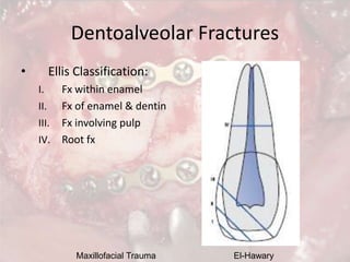 Maxillofacial Trauma El-Hawary
Dentoalveolar Fractures
• Ellis Classification:
I. Fx within enamel
II. Fx of enamel & dent...