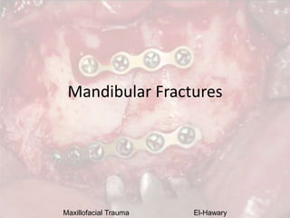 Maxillofacial Trauma El-Hawary
Mandibular Fractures
 
