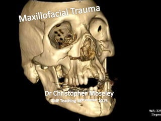 Maxillofacial trauma | PPT