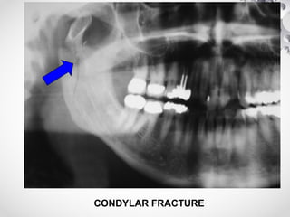 CONDYLAR FRACTURE
 