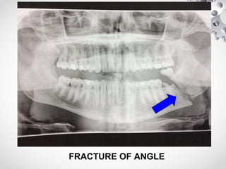 FRACTURE OF ANGLE
 