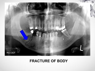 FRACTURE OF BODY
 