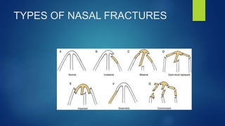 TYPES OF NASAL FRACTURES
 