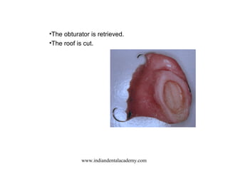 •The obturator is retrieved.
•The roof is cut.
www.indiandentalacademy.com
 