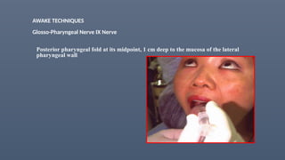 AWAKE TECHNIQUES
Glosso-Pharyngeal Nerve IX Nerve
Posterior pharyngeal fold at its midpoint, 1 cm deep to the mucosa of the lateral
pharyngeal wall
 