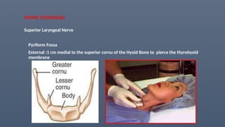 AWAKE TECHNIQUES
Superior Laryngeal Nerve
Pyriform Fossa
External :1 cm medial to the superior cornu of the Hyoid Bone to pierce the thyrohyoid
membrane
 