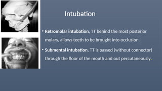 Intubation
• Retromolar intubation, TT behind the most posterior
molars, allows teeth to be brought into occlusion.
• Submental intubation, TT is passed (without connector)
through the floor of the mouth and out percutaneously.
 