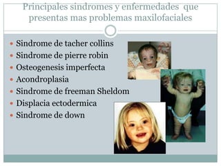Principales sindromes y enfermedades que
    presentas mas problemas maxilofaciales

 Sindrome de tacher collins
 Sindrome de pierre robin
 Osteogenesis imperfecta
 Acondroplasia
 Sindrome de freeman Sheldom
 Displacia ectodermica
 Sindrome de down
 