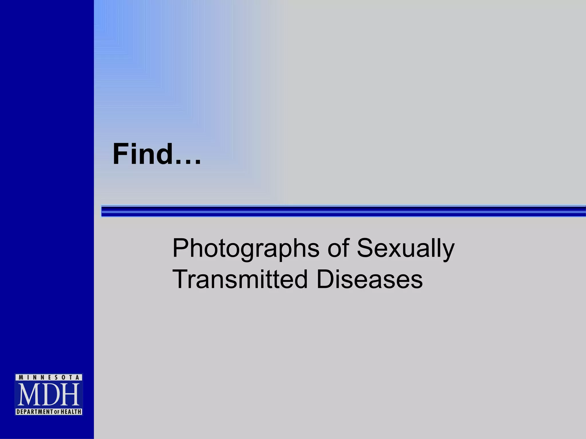 Find… Photographs of Sexually Transmitted Diseases  