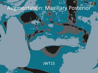Augmentation: Maxillary Posterior
JWT15
 