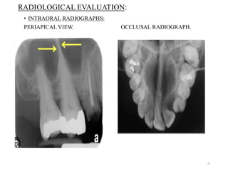 Maxillary sinus anatomy and sinus agumentation | PDF