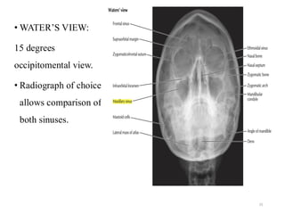 Walters View Maxillary sinus anatomy and sinus agumentation | PDF