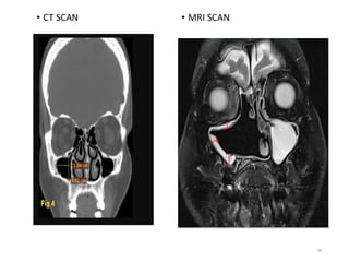 Maxillary sinus anatomy and sinus agumentation | PDF