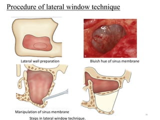 Maxillary sinus anatomy and sinus agumentation | PDF