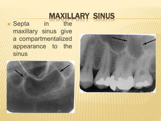 MAXILLARY SINUS
 Septa in the
maxillary sinus give
a compartmentalized
appearance to the
sinus
 