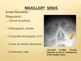 MAXILLARY SINUS
Acute Sinusitis:
Diagnosis :
 Typical symptoms
 Radiographic studies
 Computed tomography (CT)
 Check for dental abscesses
 Endoscopic view
Left-sided maxillar sinusitis
(Absence of the air transparency
of left maxillar sinus)
 