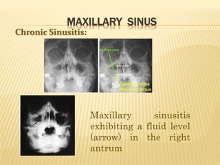 MAXILLARY SINUS
Chronic Sinusitis:
Maxillary sinusitis
exhibiting a fluid level
(arrow) in the right
antrum
 