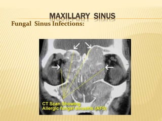 MAXILLARY SINUS
Fungal Sinus Infections:
 