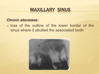 MAXILLARY SINUS
Chronic abscesses:
 loss of the outline of the lower border of the
sinus where it abutted the associated tooth
 