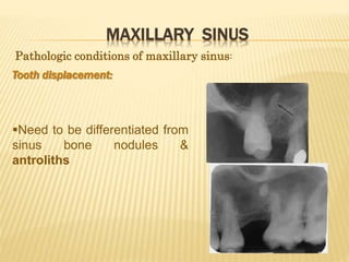 MAXILLARY SINUS
Tooth displacement:
Need to be differentiated from
sinus bone nodules &
antroliths
Pathologic conditions of maxillary sinus:
 
