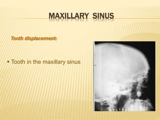 MAXILLARY SINUS
Tooth displacement:
 Tooth in the maxillary sinus
 