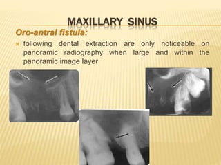MAXILLARY SINUS
Oro-antral fistula:
 following dental extraction are only noticeable on
panoramic radiography when large and within the
panoramic image layer
 