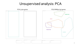 32
Unsupervised analysis: PCA
PCA 7,000 genes PCA PAM50 (35) genes
Normal-like
Basal
Claudin-low
Luminal
 