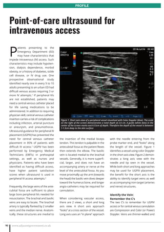 P
atients presenting to the
Emergency Department (ED)
may have characteristics that
impede intravenous (IV) access. Such
characteristics may include hypoten-
sion, dialysis dependence, morbid
obesity, or a history of diabetes, sickle
cell disease, or IV drug use. One
prospective observational study
identified nearly one in every 9 to 10
adults presenting to an urban ED had
difficult venous access requiring 3 or
more IV attempts.1
If peripheral IVs
are not established, patients may
need a central venous catheter placed
for life saving medications to be
administered. In addition to requiring
physician skill, central venous catheter
insertion carries a risk of complications
including infection, arterial puncture
or aneurysm, and pneumothorax.
Ultrasound-guidance for peripheral IV
placement (UGPIV) has prevented the
need for central venous catheter
placement in 85% of patients with
difficult IV access.2
UGPIV has been
performed by Emergency Medical
Technicians (EMTs) in prehospital
settings, as well as nurses and
physicians. Patients who have been
identified as having difficult access,
have higher patient satisfaction
scores when ultrasound is used in
peripheral IV access attempts.3
Frequently, the large veins of the ante-
cubital fossa are sufficient to place
large bore peripheral IVs needed for
resuscitation. The brachial and basilic
veins are easy to locate. The brachial
artery is typically flanked by 2 smaller
veins and the median nerve. Anatom-
ically, these structures are medial to
the insertion of the medial biceps
tendon. This tendon is palpable in the
antecubital fossa as the patient flexes
then extends the elbow. The basilic
vein is located medial to the brachial
vessels. Generally, it is more superfi-
cial, larger, and does not have an
accompanying artery or nerve at the
level of the antecubital fossa. As you
move proximally up the arm (towards
the head) the basilic vein dives deeper
toward the humerus bone, and longer
angio-catheters may be required for
cannulation.
When considering vascular access,
there are 2 views, a short and long
axis view. A short axis approach
“looks” at a cross section of the vessel.
Long axis uses an “in plane” approach
with the needle entering from the
probe marker end, and “looks” along
the length of the vessel. Figure 1
identifies a vessel using color Doppler
in the short axis view. Figure 2 demon-
strates a long axis view with the
needle and tip seen in the vessel.
While both short and long approaches
may be used for UGPIV placement,
the benefit for the short axis is the
ability to identify target veins as well
as accompanying non-target (arteries
and nerve) structures.
Identify the Vein:
Remember the C’s
The two C’s to remember for UGPIV
access or for central venous cannulation
are Compression and Color (or Power)
Doppler. Veins are thinner-walled and
www.adjacentgovernment.co.uk90
Point-of-care ultrasound for
intravenous access
PROFILE
Figure 1. Short axis view of a peripheral vessel visualised with Color Doppler (blue). The scale
on the right of the screen demonstrates a total depth of 2.6 cm. A guide (white dots) in the
center of the screen marks each 0.5cm of depth. Therefore the depth of the vessel is between
1-1.5cm deep to the skin surface
 
