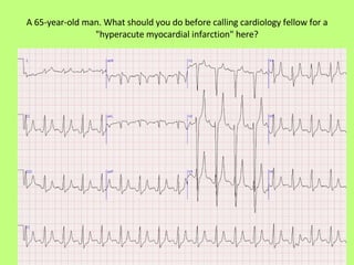 A 65-year-old man. What should you do before calling cardiology fellow for a "hyperacute myocardial infarction" here? 