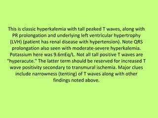This is classic hyperkalemia with tall peaked T waves, along with PR prolongation and underlying left ventricular hypertrophy (LVH) (patient has renal disease with hypertension). Note QRS prolongation also seen with moderate-severe hyperkalemia. Potassium here was 9.6mEq/L. Not all tall positive T waves are "hyperacute." The latter term should be reserved for increased T wave positivity secondary to transmural ischemia. Major clues include narrowness (tenting) of T waves along with other findings noted above. 