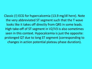 Classic (!) ECG for hypercalcemia (13.9 mg/dl here). Note the very abbreviated ST segment such that the T wave looks like it takes off directly from QRS in some leads. High take-off of ST segment in V2/V3 is also sometimes seen in this context. Hypocalcemia is just the opposite: prolonged QT due to long ST segment (corresponding to changes in action potential plateau phase duration). 