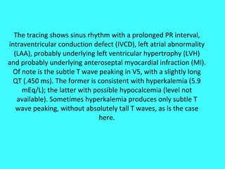 The tracing shows sinus rhythm with a prolonged PR interval, intraventricular conduction defect (IVCD), left atrial abnormality (LAA), probably underlying left ventricular hypertrophy (LVH) and probably underlying anteroseptal myocardial infraction (MI). Of note is the subtle T wave peaking in V5, with a slightly long QT (.450 ms). The former is consistent with hyperkalemia (5.9 mEq/L); the latter with possible hypocalcemia (level not available). Sometimes hyperkalemia produces only subtle T wave peaking, without absolutely tall T waves, as is the case here. 