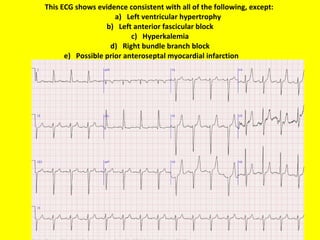 This ECG shows evidence consistent with all of the following, except:    a)   Left ventricular hypertrophy b)   Left anterior fascicular block c)   Hyperkalemia d)   Right bundle branch block e)   Possible prior anteroseptal myocardial infarction 