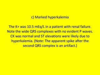 c) Marked hyperkalemia The K+ was 10.5 mEq/L in a patient with renal failure. Note the wide QRS complexes with no evident P waves. CK was normal and ST elevations were likely due to hyperkalemia. (Note: The apparent spike after the second QRS complex is an artifact.) 