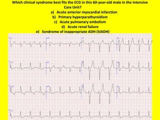 Which clinical syndrome best fits the ECG in this 60-year-old male in the Intensive Care Unit?    a)   Acute anterior myocardial infarction b)   Primary hyperparathyroidism c)   Acute pulmonary embolism d)   Acute renal failure e)   Syndrome of inappropriate ADH (SIADH) 