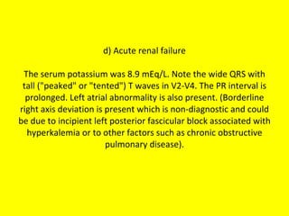 d) Acute renal failure The serum potassium was 8.9 mEq/L. Note the wide QRS with tall ("peaked" or "tented") T waves in V2-V4. The PR interval is prolonged. Left atrial abnormality is also present. (Borderline right axis deviation is present which is non-diagnostic and could be due to incipient left posterior fascicular block associated with hyperkalemia or to other factors such as chronic obstructive pulmonary disease). 