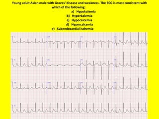 Young adult Asian male with Graves' disease and weakness. The ECG is most consistent with which of the following:     a)   Hypokalemia b)   Hyperkalemia c)   Hypocalcemia d)   Hypercalcemia e)   Subendocardial ischemia 