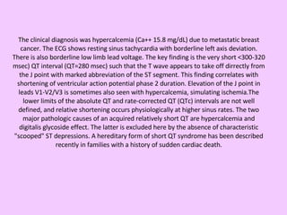 The clinical diagnosis was hypercalcemia (Ca++ 15.8 mg/dL) due to metastatic breast cancer. The ECG shows resting sinus tachycardia with borderline left axis deviation. There is also borderline low limb lead voltage. The key finding is the very short <300-320 msec) QT interval (QT=280 msec) such that the T wave appears to take off dirrectly from the J point with marked abbreviation of the ST segment. This finding correlates with shortening of ventricular action potential phase 2 duration. Elevation of the J point in leads V1-V2/V3 is sometimes also seen with hypercalcemia, simulating ischemia.The lower limits of the absolute QT and rate-corrected QT (QTc) intervals are not well defined, and relative shortening occurs physiologically at higher sinus rates. The two major pathologic causes of an acquired relatively short QT are hypercalcemia and digitalis glycoside effect. The latter is excluded here by the absence of characteristic "scooped" ST depressions. A hereditary form of short QT syndrome has been described recently in families with a history of sudden cardiac death. 