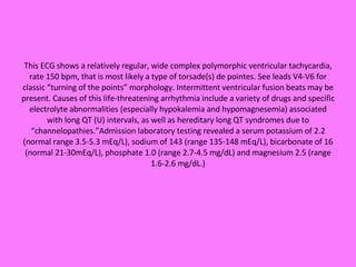 This ECG shows a relatively regular, wide complex polymorphic ventricular tachycardia, rate 150 bpm, that is most likely a type of torsade(s) de pointes. See leads V4-V6 for classic “turning of the points” morphology. Intermittent ventricular fusion beats may be present. Causes of this life-threatening arrhythmia include a variety of drugs and specific electrolyte abnormalities (especially hypokalemia and hypomagnesemia) associated with long QT (U) intervals, as well as hereditary long QT syndromes due to “channelopathies.”Admission laboratory testing revealed a serum potassium of 2.2 (normal range 3.5-5.3 mEq/L), sodium of 143 (range 135-148 mEq/L), bicarbonate of 16 (normal 21-30mEq/L), phosphate 1.0 (range 2.7-4.5 mg/dL) and magnesium 2.5 (range 1.6-2.6 mg/dL.) 