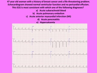 47 year old woman with a history of breast cancer and a life-threatening problem. Echocardiogram showed normal ventricular function and no pericardial effusion. This ECG is most consistent with which one of the following diagnoses?     a)   Acute subarachnoid bleed b)   Acute pulmonary embolism c)   Acute anterior myocardial infarction (MI) d)   Acute pancreatitis e)   Hypercalcemia 