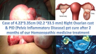 Right Ovarian cyst of 4.22ˣ3.35cm (42.2 ˣ33.5 mm) & PID (Pelvic Inflammatory Disease) and Homoeopathic medicine treatment