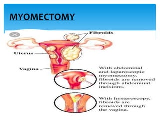 MYOMECTOMY
 