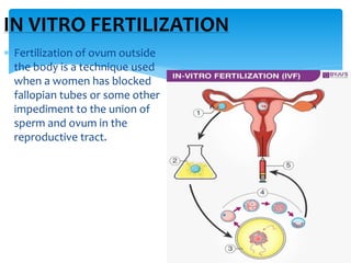 IN VITRO FERTILIZATION
 Fertilization of ovum outside
the body is a technique used
when a women has blocked
fallopian tubes or some other
impediment to the union of
sperm and ovum in the
reproductive tract.
 
